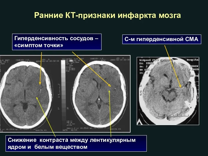 Ранние КТ-признаки инфаркта мозга Снижение контраста между лентикулярным ядром и