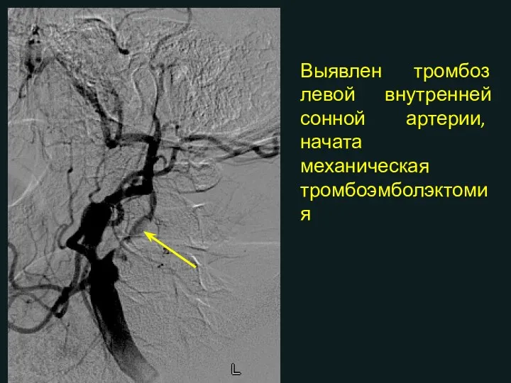 Выявлен тромбоз левой внутренней сонной артерии, начата механическая тромбоэмболэктомия