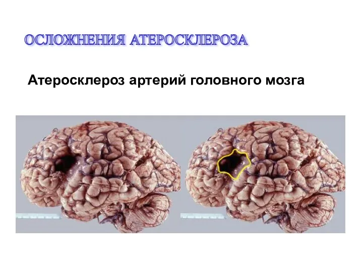ОСЛОЖНЕНИЯ АТЕРОСКЛЕРОЗА Атеросклероз артерий головного мозга