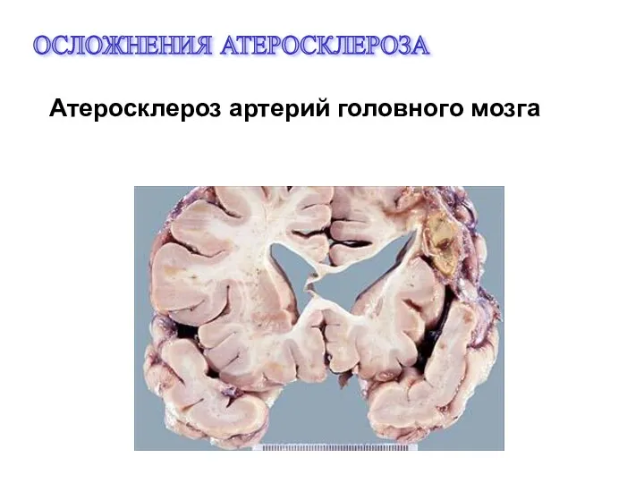 ОСЛОЖНЕНИЯ АТЕРОСКЛЕРОЗА Атеросклероз артерий головного мозга