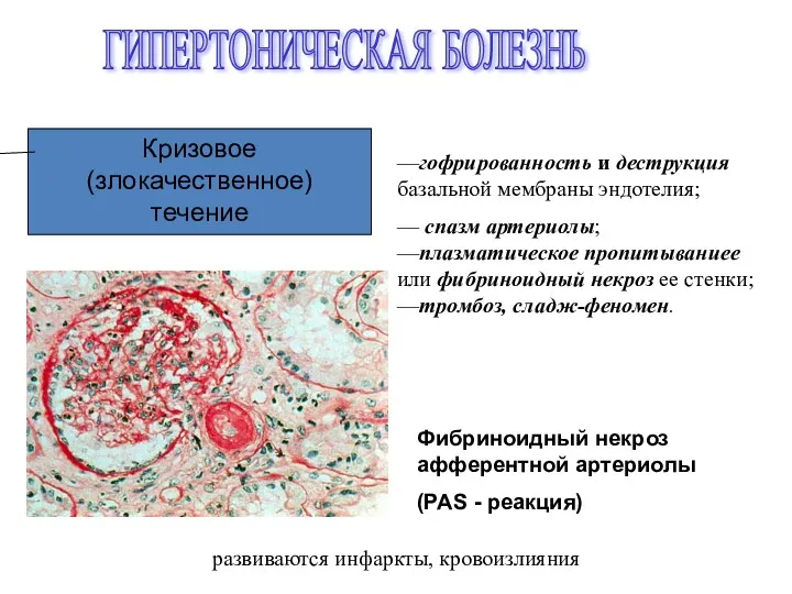 ГИПЕРТОНИЧЕСКАЯ БОЛЕЗНЬ Кризовое (злокачественное) течение Фибриноидный некроз афферентной артериолы (PAS - реакция) —гофрированность