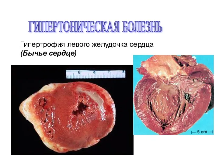 ГИПЕРТОНИЧЕСКАЯ БОЛЕЗНЬ Гипертрофия левого желудочка сердца (Бычье сердце)