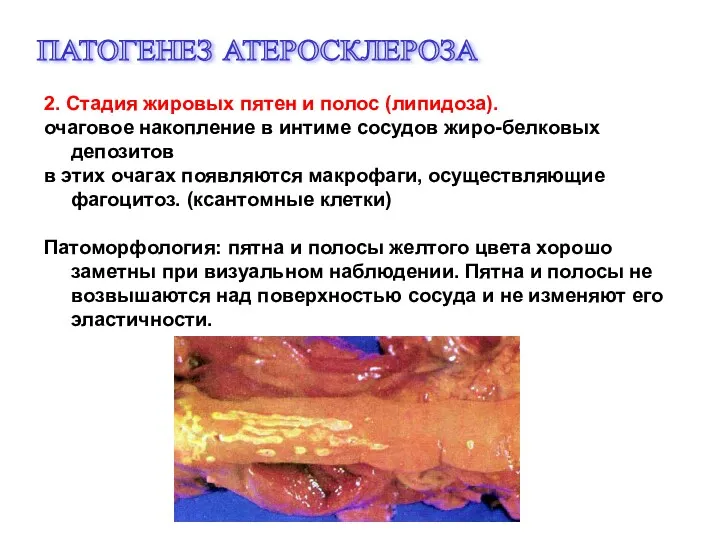 ПАТОГЕНЕЗ АТЕРОСКЛЕРОЗА 2. Стадия жировых пятен и полос (липидоза). очаговое накопление в интиме