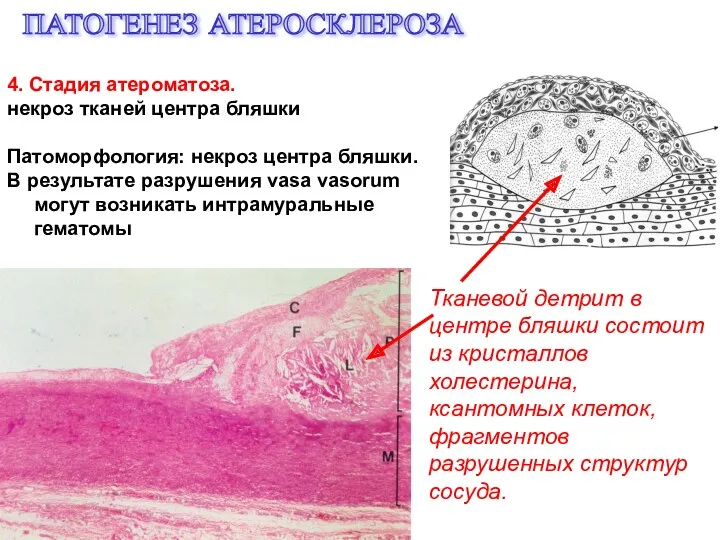 ПАТОГЕНЕЗ АТЕРОСКЛЕРОЗА 4. Стадия атероматоза. некроз тканей центра бляшки Патоморфология: некроз центра бляшки.