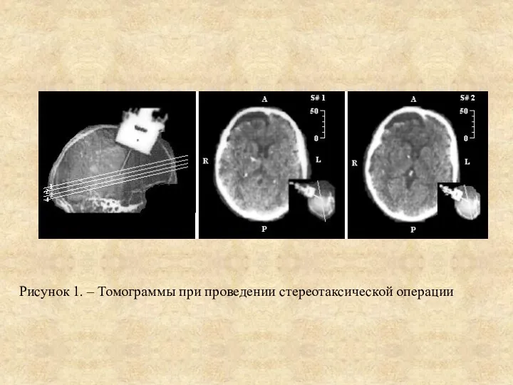 Рисунок 1. – Томограммы при проведении стереотаксической операции