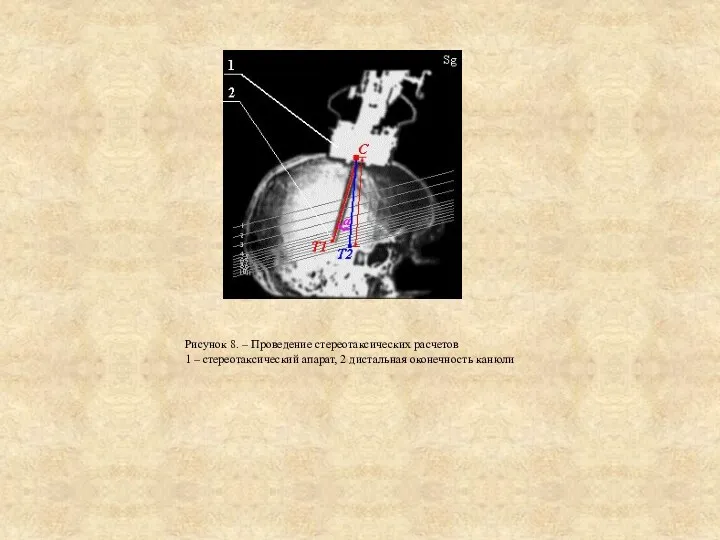 Рисунок 8. – Проведение стереотаксических расчетов 1 – стереотаксический апарат, 2 дистальная оконечность канюли