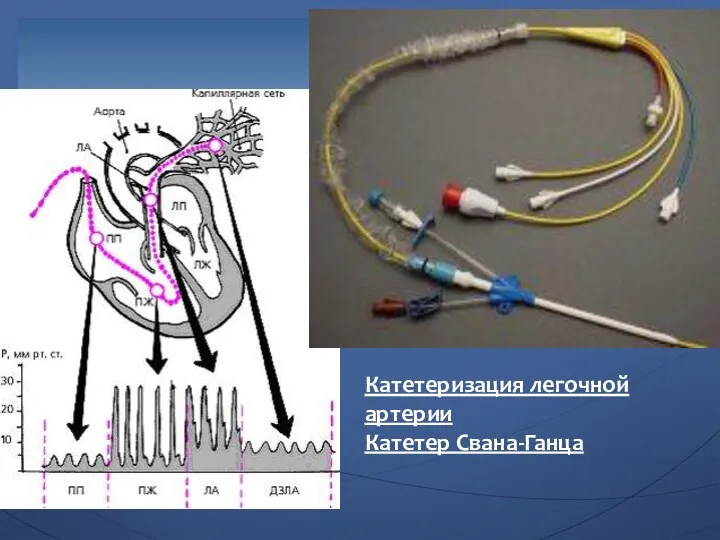 Катетеризация легочной артерии Катетер Свана-Ганца