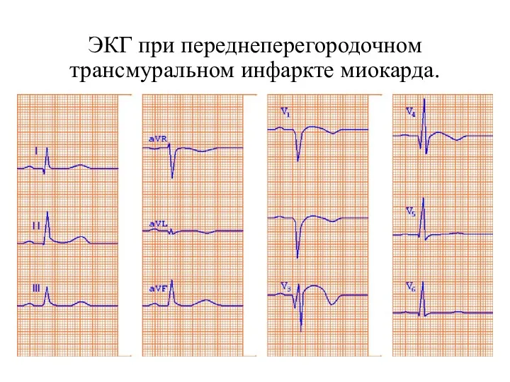 ЭКГ при переднеперегородочном трансмуральном инфаркте миокарда.