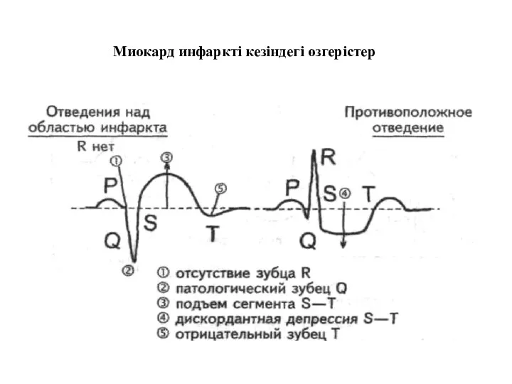 Миокард инфаркті кезіндегі өзгерістер