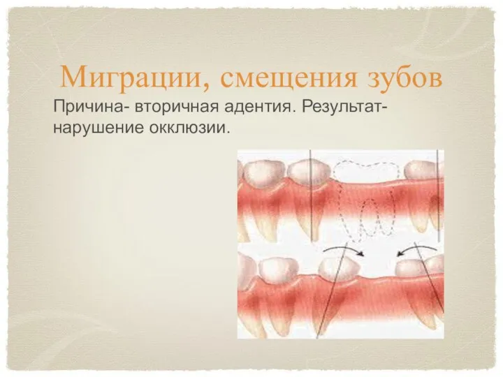Миграции, смещения зубов Причина- вторичная адентия. Результат- нарушение окклюзии.