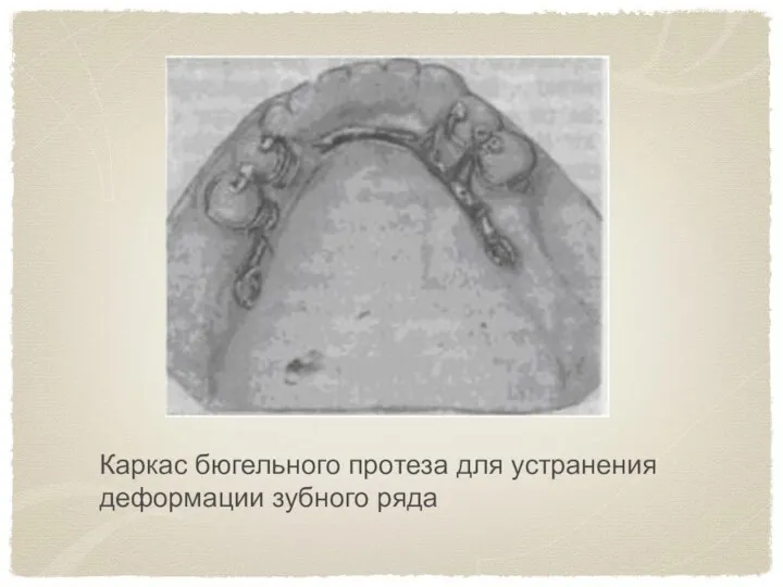 Каркас бюгельного протеза для устранения деформации зубного ряда