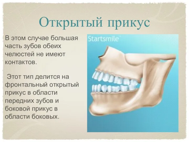 Открытый прикус В этом случае большая часть зубов обеих челюстей не имеют контактов.