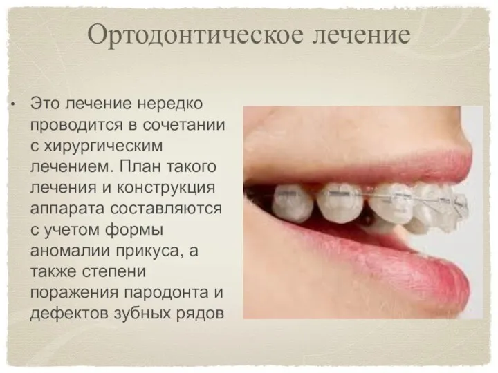 Ортодонтическое лечение Это лечение нередко проводится в сочетании с хирургическим