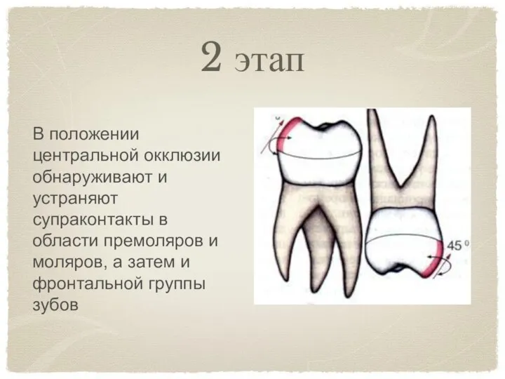 2 этап В положении центральной окклюзии обнаруживают и устраняют супраконтакты