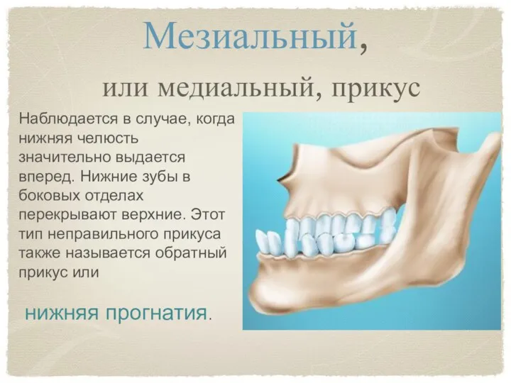 Мезиальный, или медиальный, прикус Наблюдается в случае, когда нижняя челюсть значительно выдается вперед.
