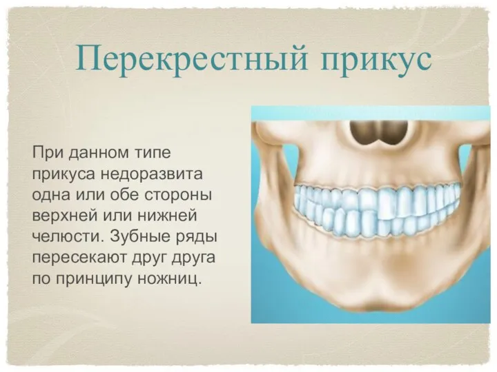 Перекрестный прикус При данном типе прикуса недоразвита одна или обе