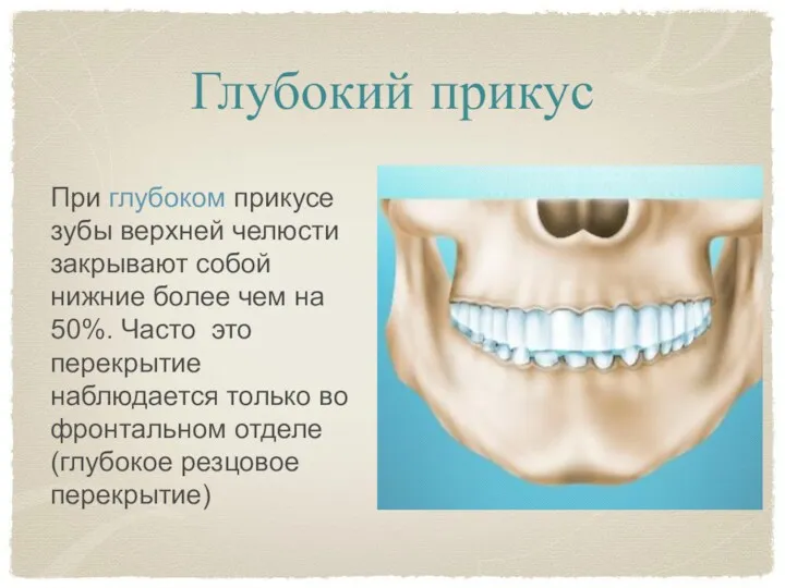 Глубокий прикус При глубоком прикусе зубы верхней челюсти закрывают собой нижние более чем