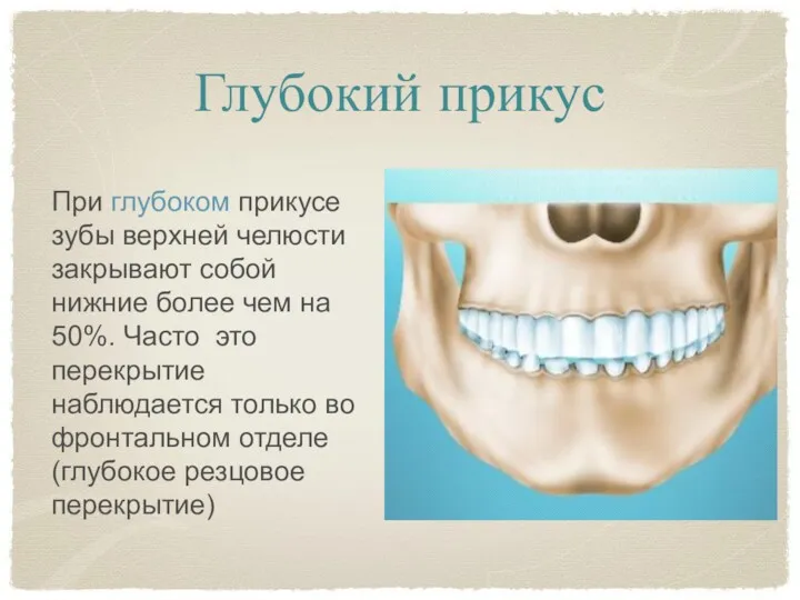 Глубокий прикус При глубоком прикусе зубы верхней челюсти закрывают собой