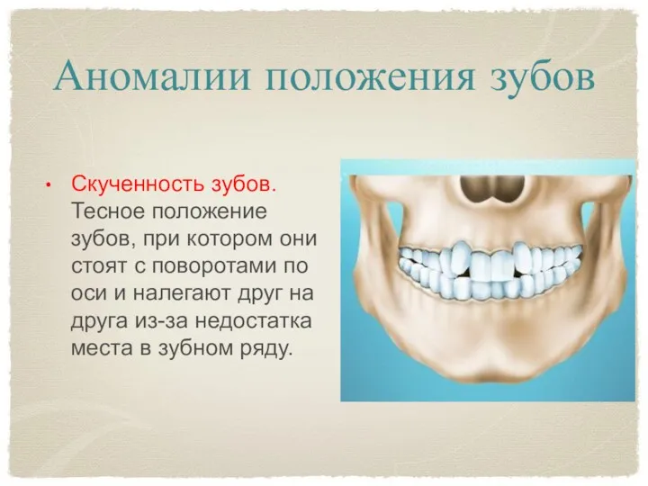 Аномалии положения зубов Скученность зубов. Тесное положение зубов, при котором они стоят с