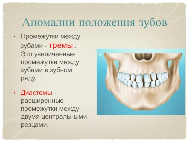 Аномалии положения зубов Промежутки между зубами - тремы . Это увеличенные промежутки между
