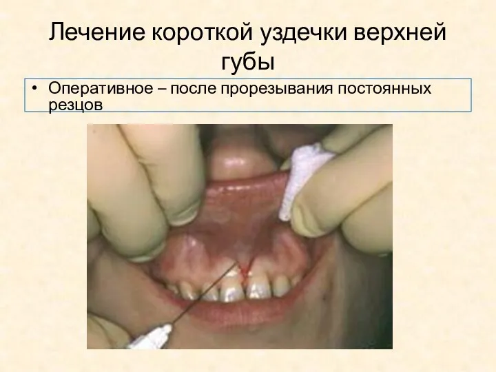 Лечение короткой уздечки верхней губы Оперативное – после прорезывания постоянных резцов
