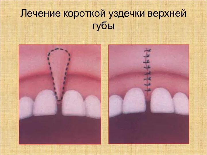 Лечение короткой уздечки верхней губы