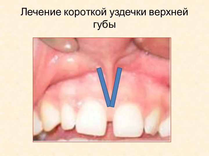 Лечение короткой уздечки верхней губы