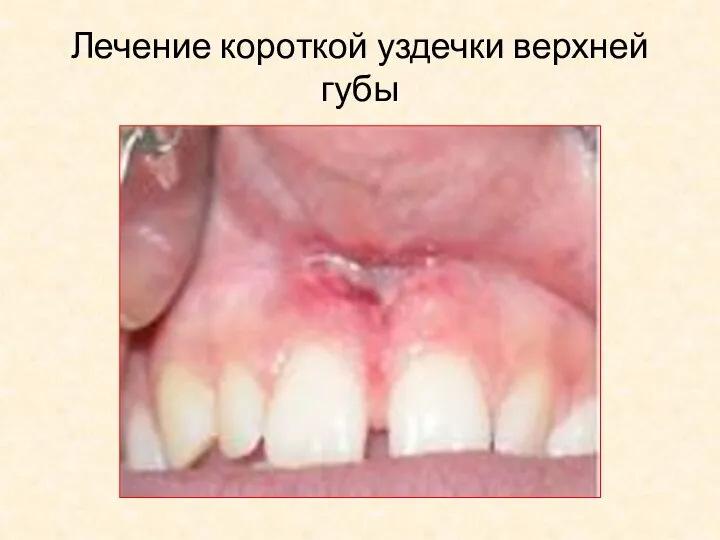 Лечение короткой уздечки верхней губы