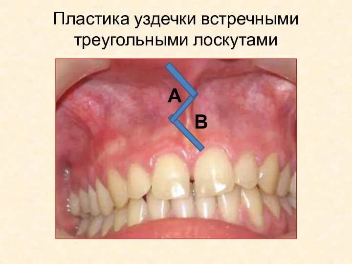 А В Пластика уздечки встречными треугольными лоскутами