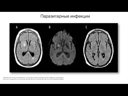 Khalaf AM, Hashim MA, Alsharabati M, et al. Late-Onset Cerebral