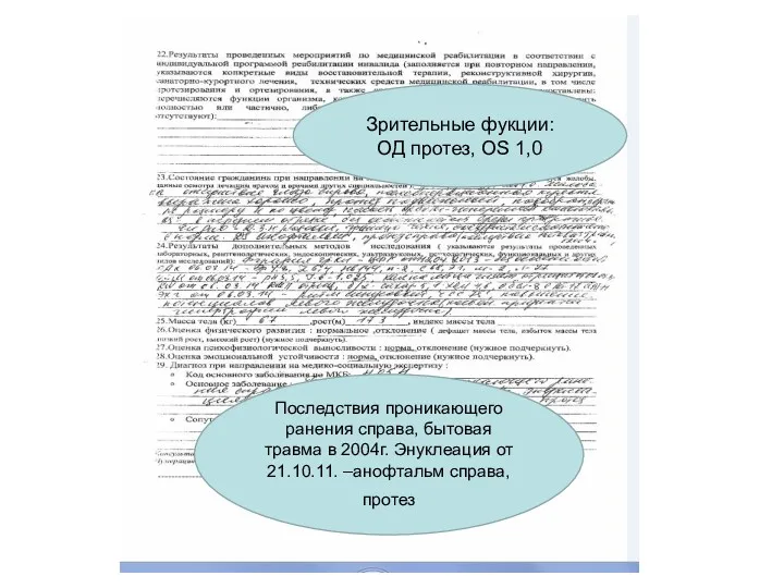 Последствия проникающего ранения справа, бытовая травма в 2004г. Энуклеация от