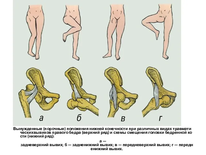 Вынужденные (порочные) положения нижней конечности при различных видах травматическихвывихов правого