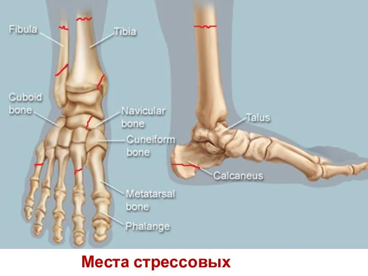 Места стрессовых переломов