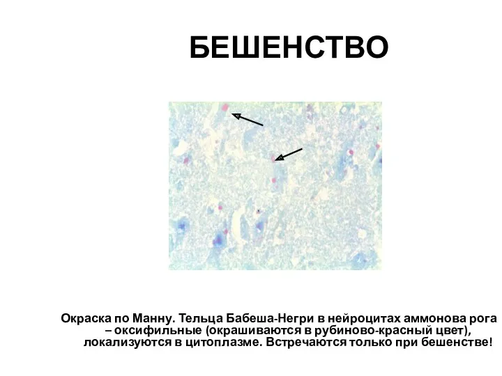 БЕШЕНСТВО Окраска по Манну. Тельца Бабеша-Негри в нейроцитах аммонова рога