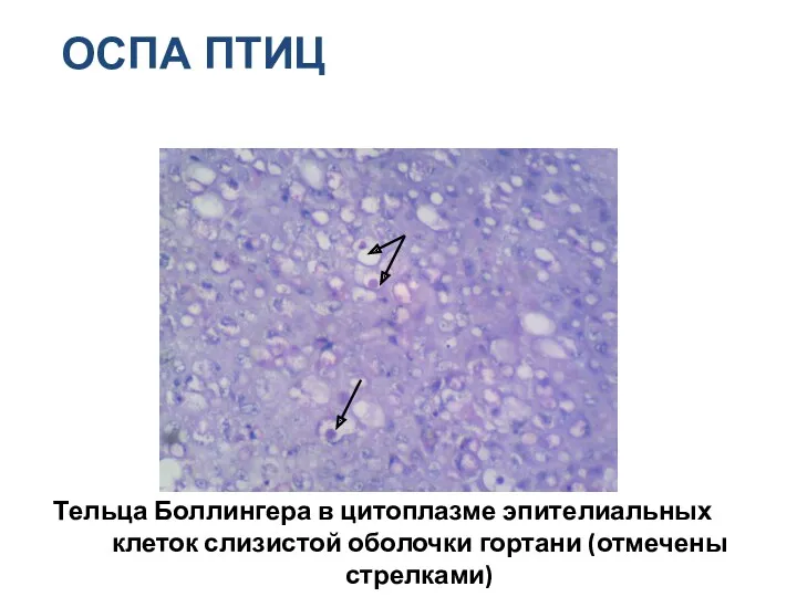 Тельца Боллингера в цитоплазме эпителиальных клеток слизистой оболочки гортани (отмечены стрелками) ОСПА ПТИЦ
