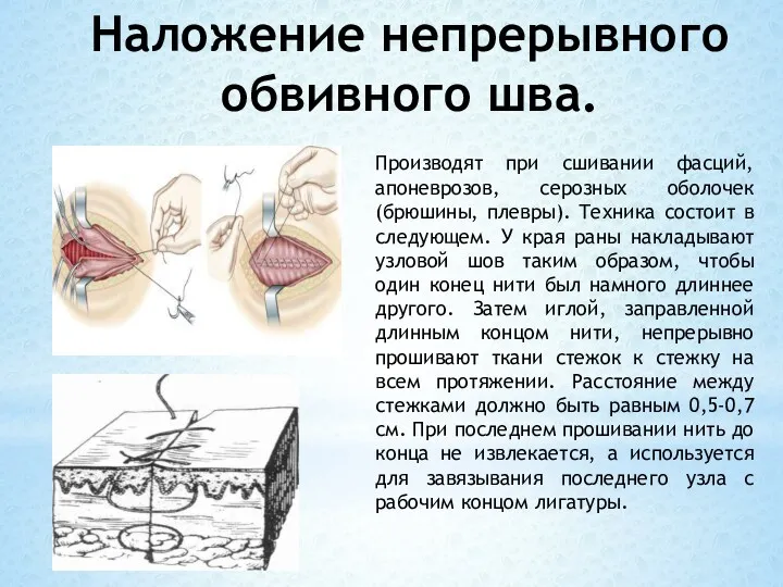 Наложение непрерывного обвивного шва. Производят при сшивании фасций, апоневрозов, серозных оболочек (брюшины, плевры).