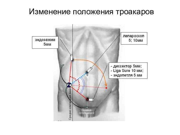 Изменение положения троакаров