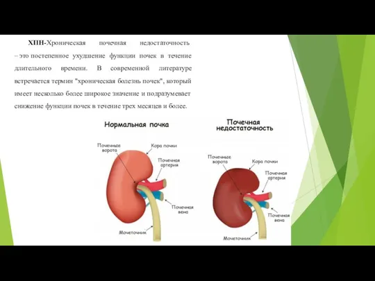 ХПН-Хроническая почечная недостаточность – это постепенное ухудшение функции почек в