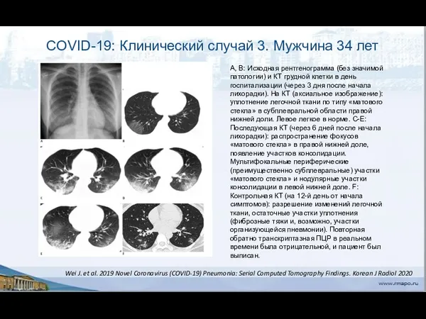 COVID-19: Клинический случай 3. Мужчина 34 лет А, В: Исходная