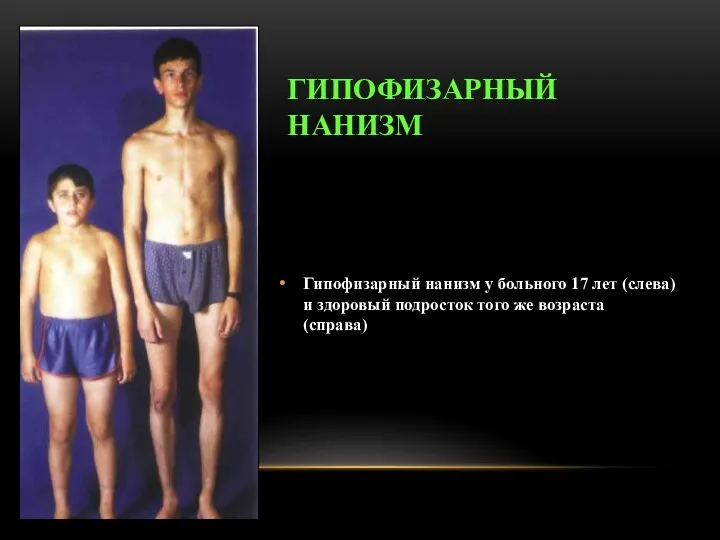 ГИПОФИЗАРНЫЙ НАНИЗМ Гипофизарный нанизм у больного 17 лет (слева) и здоровый подросток того же возраста (справа)