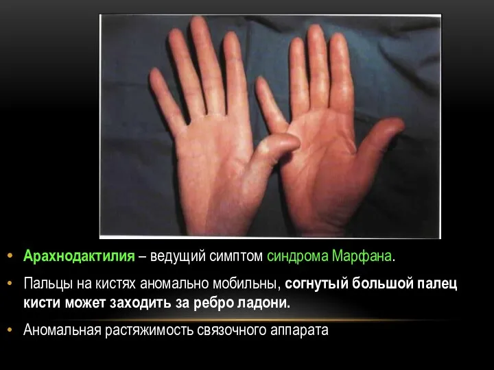 Арахнодактилия – ведущий симптом синдрома Марфана. Пальцы на кистях аномально мобильны, согнутый большой
