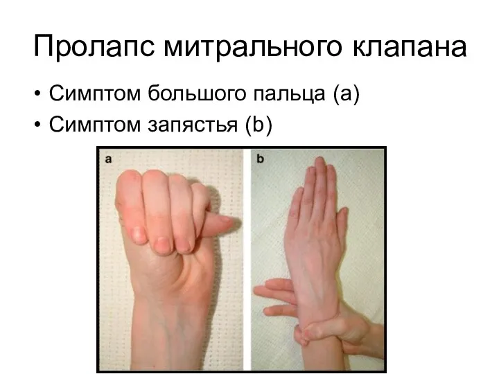 Пролапс митрального клапана Симптом большого пальца (а) Симптом запястья (b)