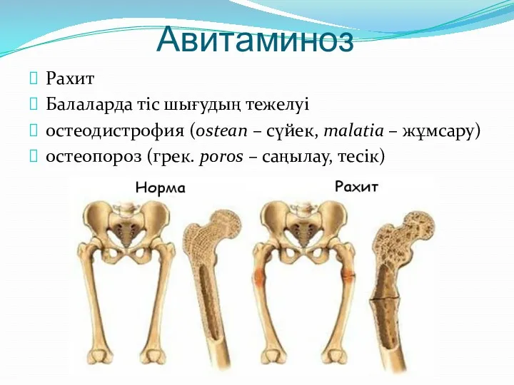 Авитаминоз Рахит Балаларда тіс шығудың тежелуі остеодистрофия (ostean – сүйек,