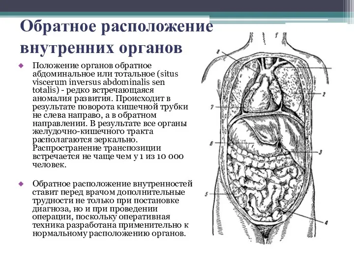 Обратное расположение внутренних органов Положение органов обратное абдоминальное или тотальное (situs viscerum inversus