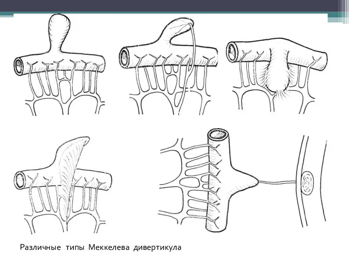 Различные типы Меккелева дивертикула