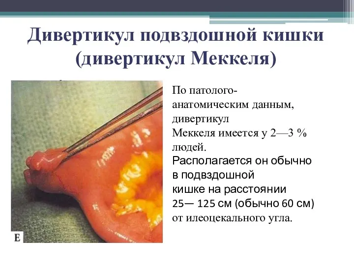 Дивертикул подвздошной кишки (дивертикул Меккеля) По патолого-анатомическим данным, дивертикул Меккеля имеется у 2—3