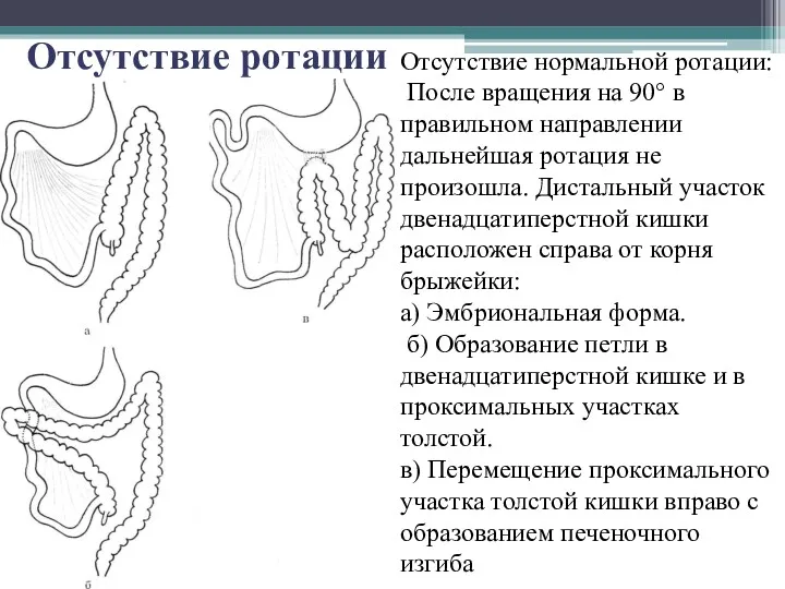 Отсутствие ротации Отсутствие нормальной ротации: После вращения на 90° в правильном направлении дальнейшая