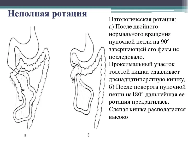 Неполная ротация Патологическая ротация: а) После двойного нормального вращения пупочной петли на 90°