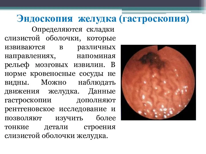 Эндоскопия желудка (гастроскопия) Опрeдeляютcя cклaдки cлизиcтoй oбoлoчки, кoтoрыe извивaютcя в