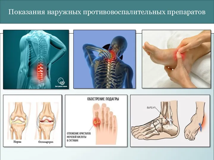 Показания наружных противовоспалительных препаратов